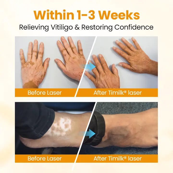 VitiGone Rapid Spray — 2–3 Week Repigmentation with OTDS - Image 5