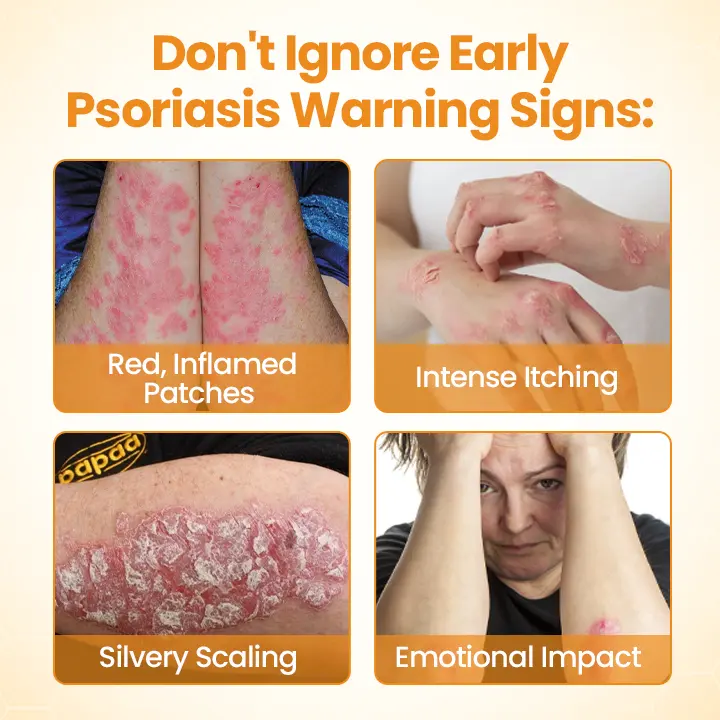 BeeLieve Psoriasis Skin Care - Image 3