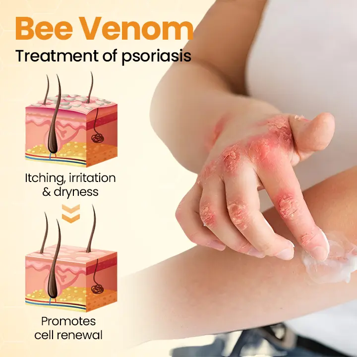 BeeLieve Psoriasis Skin Care - Image 5