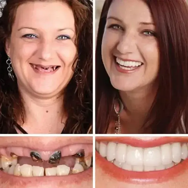 Medical Full Denture with Strong Suctiond - Image 10