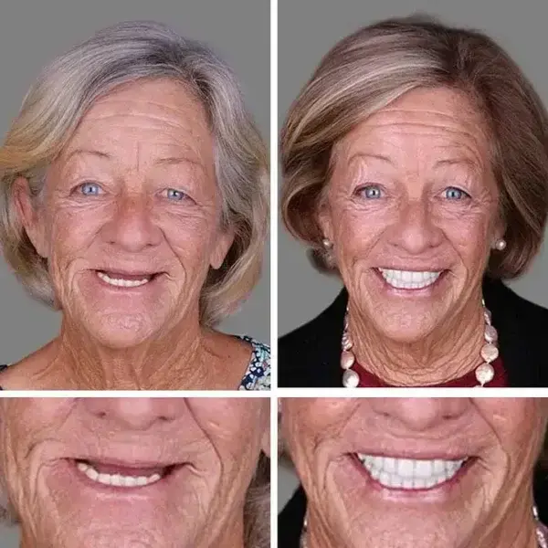 Medical Full Denture with Strong Suctiond - Image 11