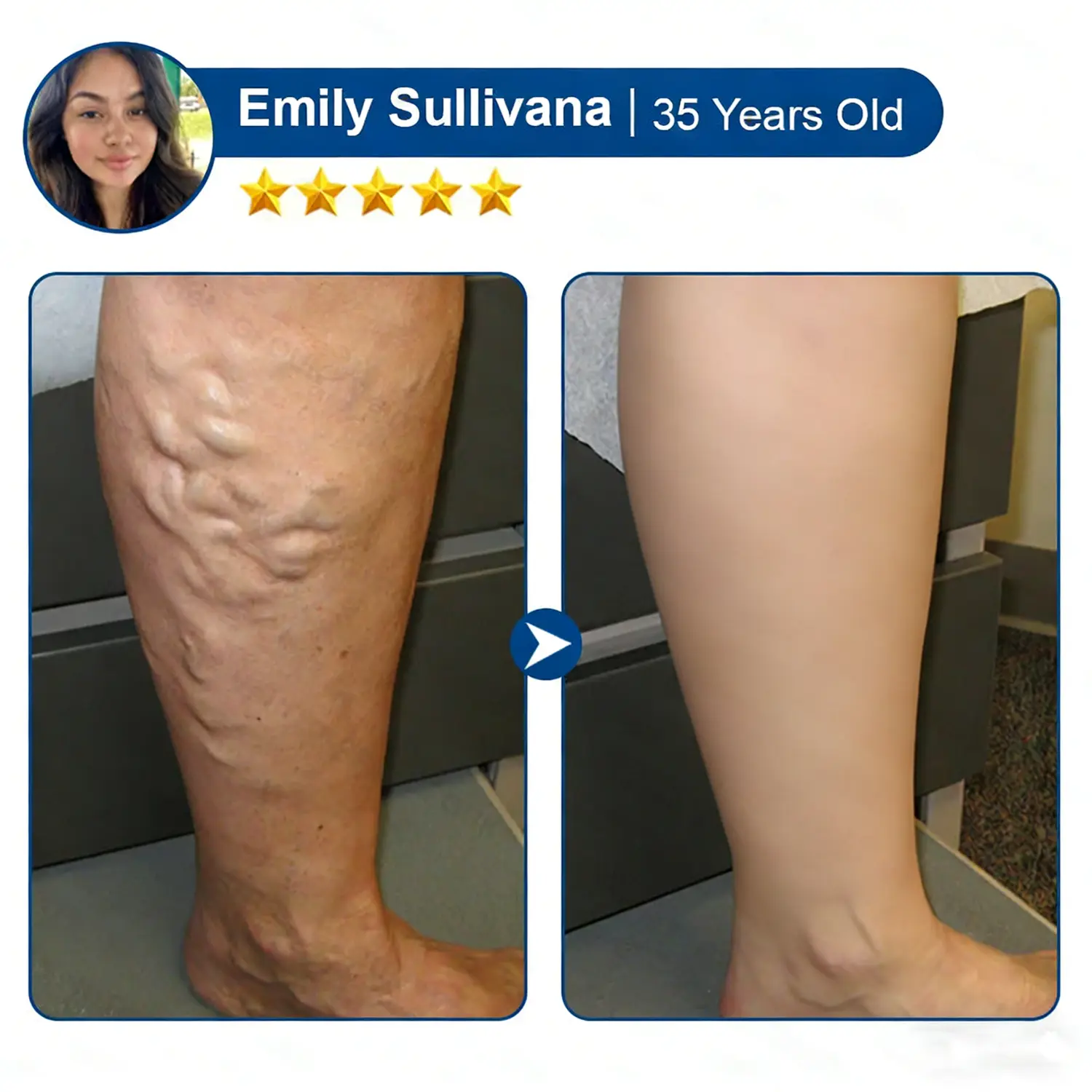 Vein Contour Micro-Patches: The 7-Day Transformation for Varicose Veins - Image 13