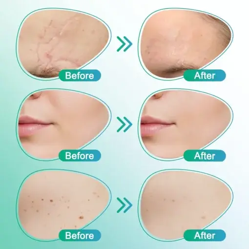 3-in-1 Microneedle Care Patch - Image 6