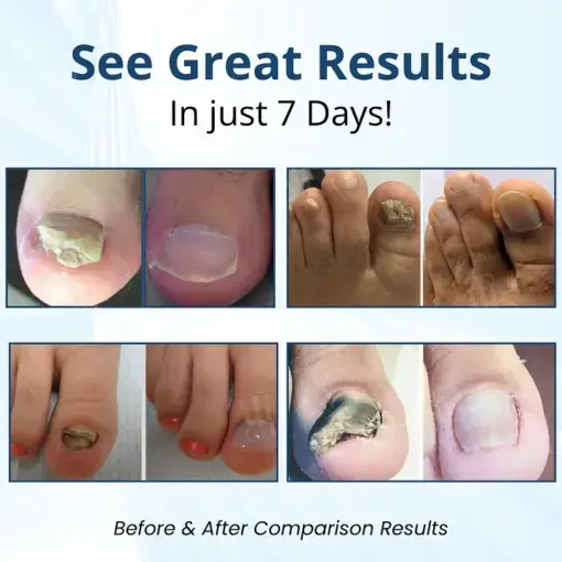 Pro Fungal Nail Patches - Image 2