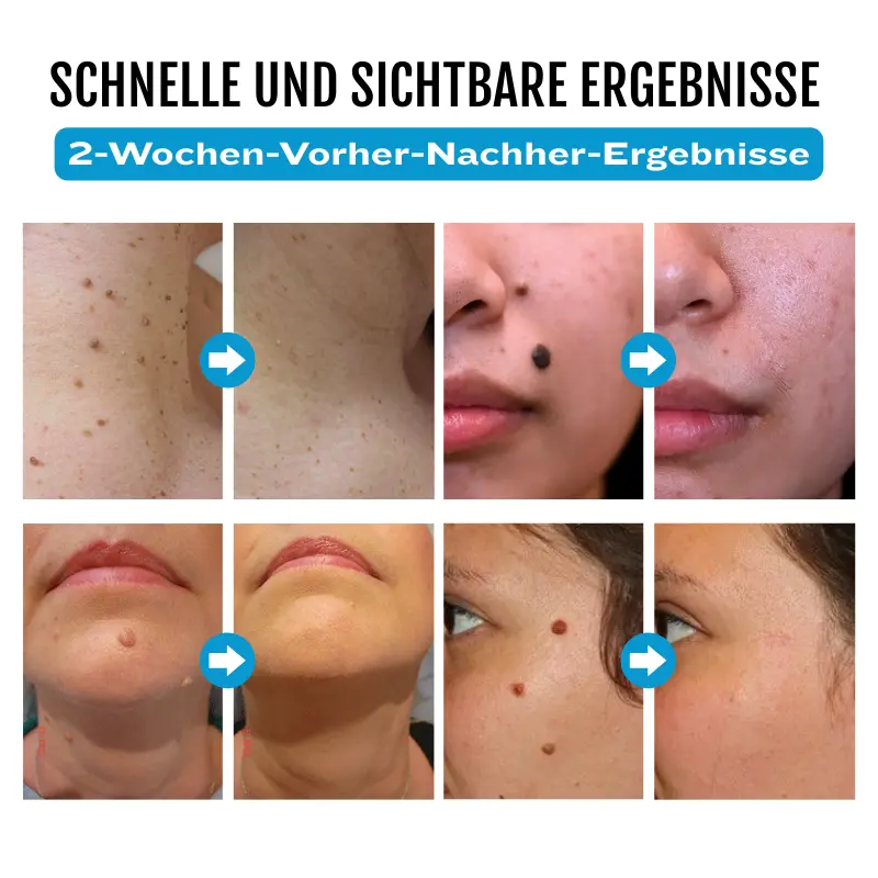 SpotlessDerm Molen- und Warzen-Laserstift - Image 4