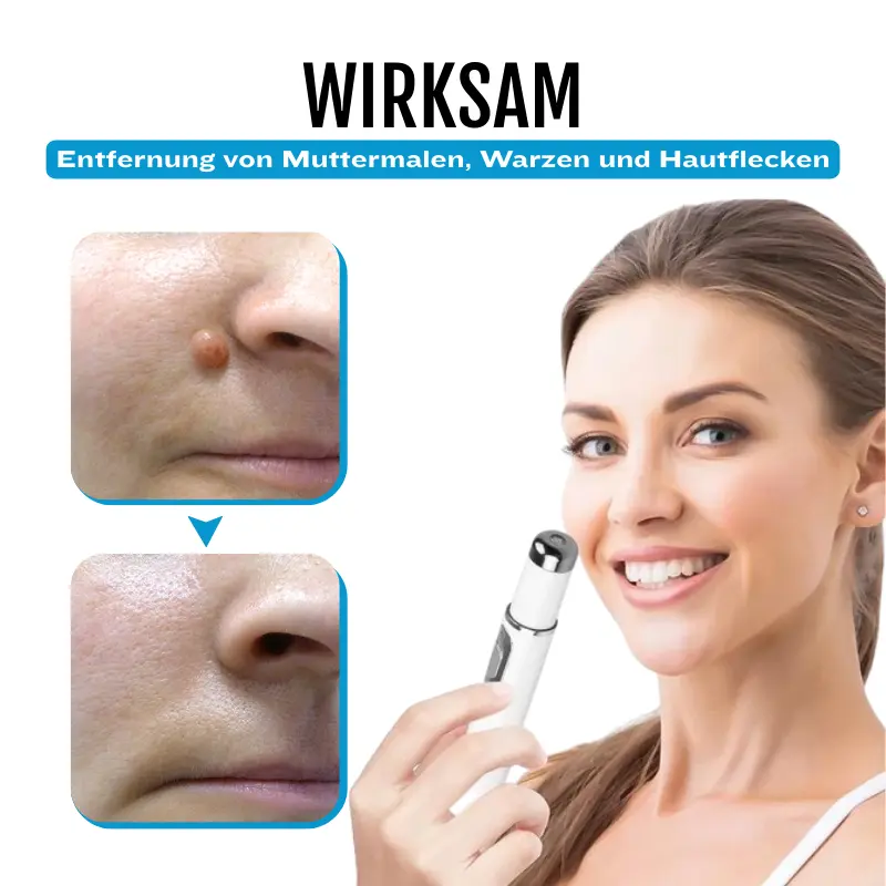 SpotlessDerm Molen- und Warzen-Laserstift - Image 5