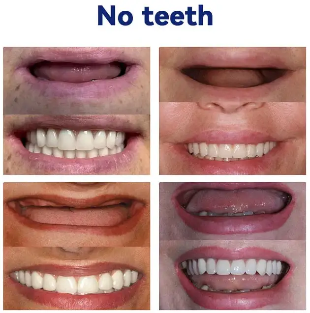 Advanced Full Denture Set - Image 7