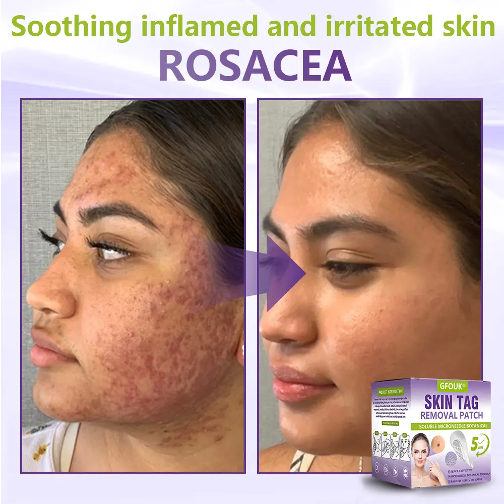 Soluble Microneedle Botanical Skin Tag Removal Patch - Image 10