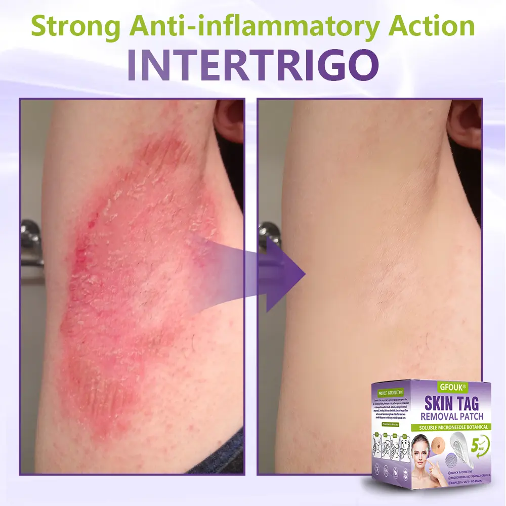 Soluble Microneedle Botanical Skin Tag Removal Patch - Image 11