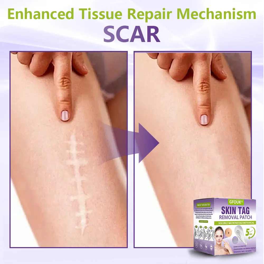 Soluble Microneedle Botanical Skin Tag Removal Patch - Image 12