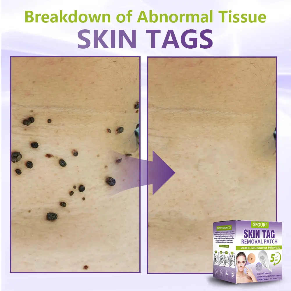 Soluble Microneedle Botanical Skin Tag Removal Patch - Image 4