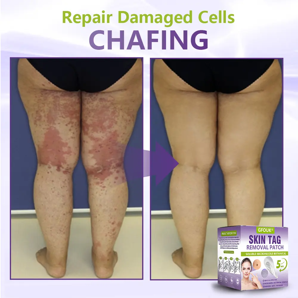 Soluble Microneedle Botanical Skin Tag Removal Patch - Image 6