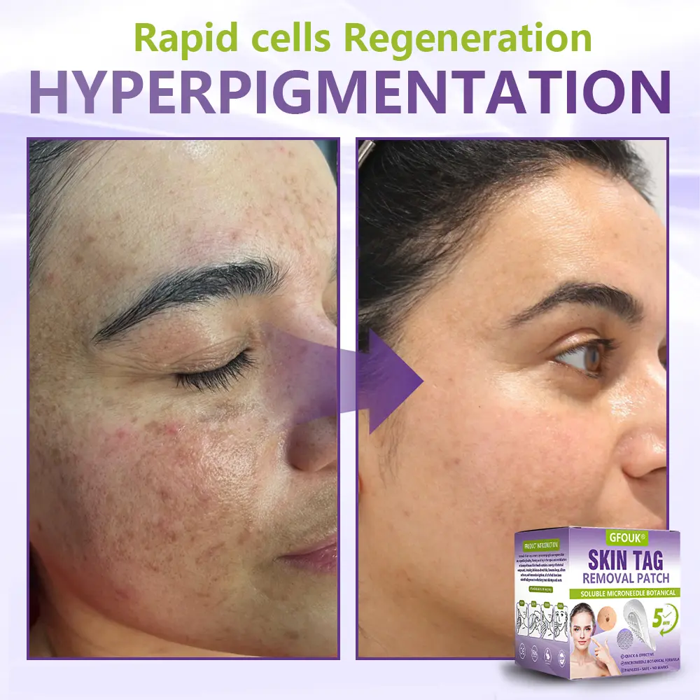 Soluble Microneedle Botanical Skin Tag Removal Patch - Image 7
