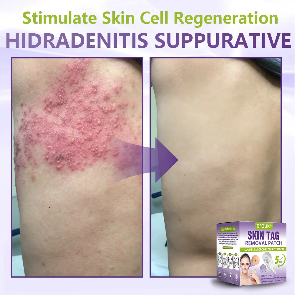 Soluble Microneedle Botanical Skin Tag Removal Patch - Image 8