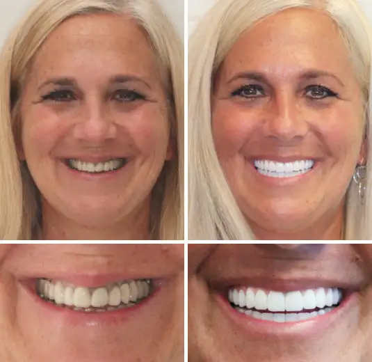 Made in Germany Advanced Customized Full Denture Set - Image 7