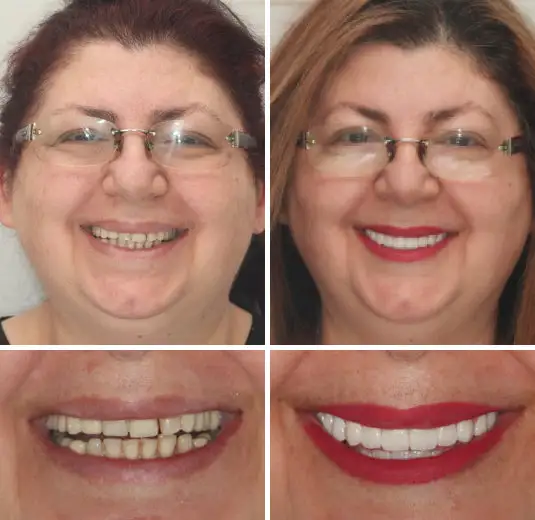 Made in Germany Advanced Customized Full Denture Set - Image 9