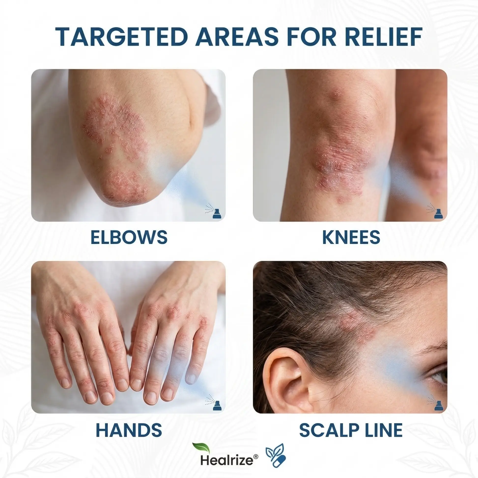 Magnesium Botanical Spray –Advanced Skin Recovery for Psoriasis & Eczema - Image 2