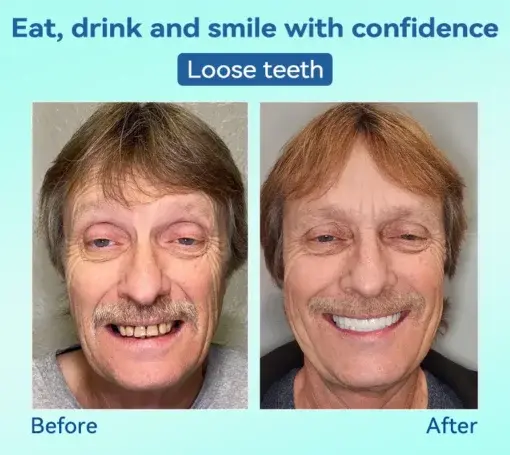 Premium Denture AdaptableFit Functional Dentures - Image 10