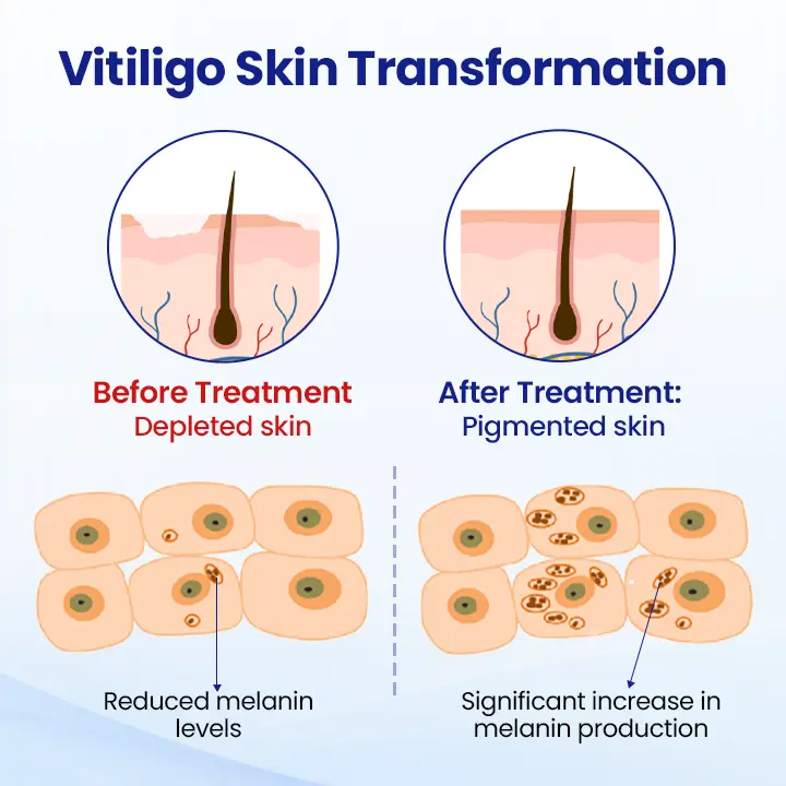 Vitiligo Repigmentation Spray - Image 4