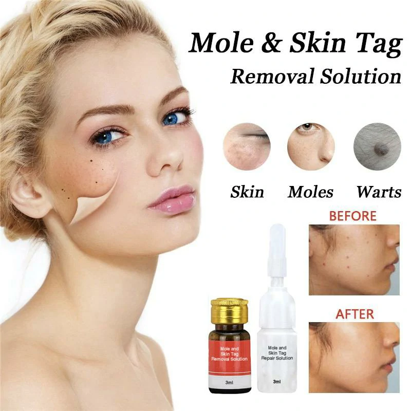 Mole & Skin Tag Removal Solution - Image 3