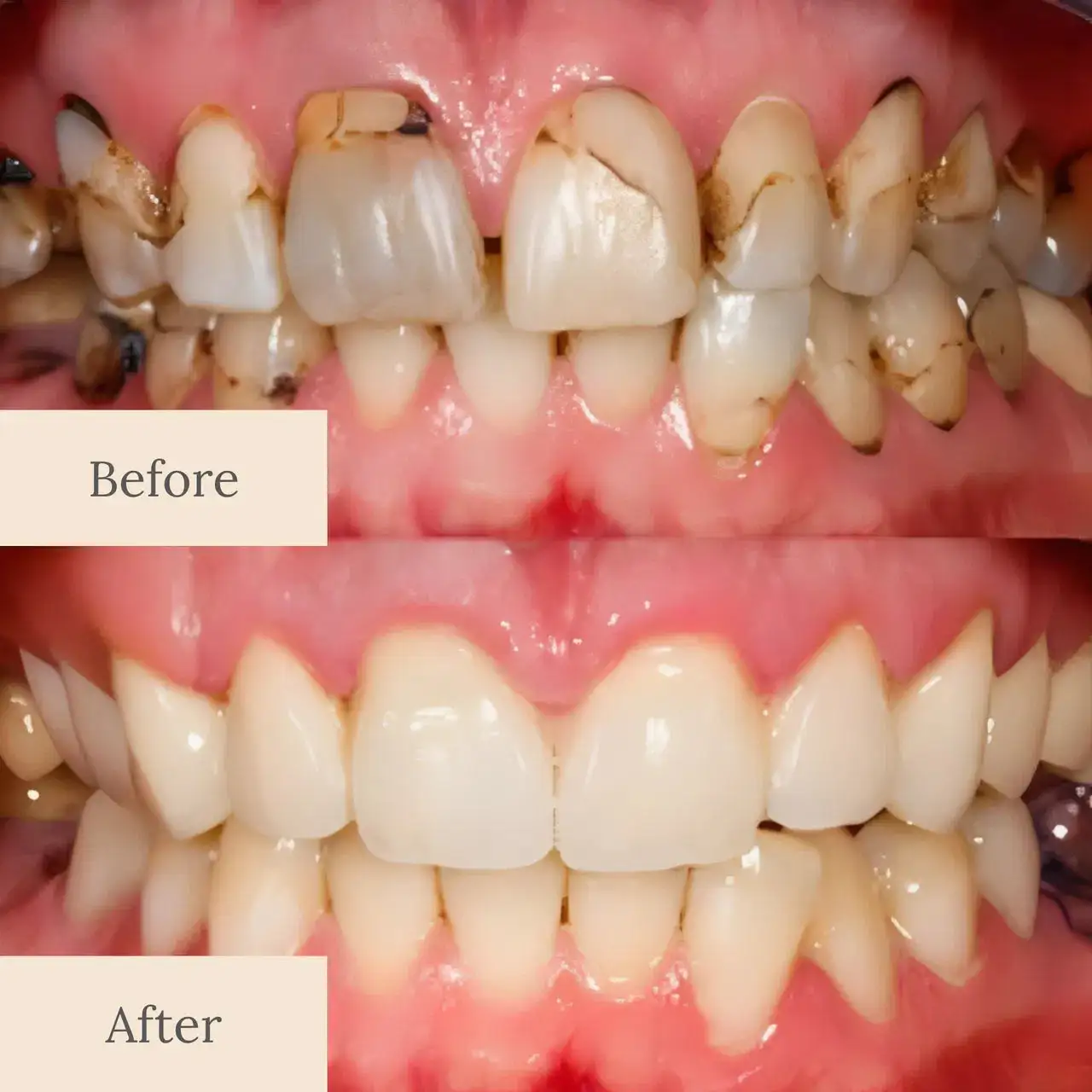 Advanced Enamel Repair & Whitening Kit - Image 8