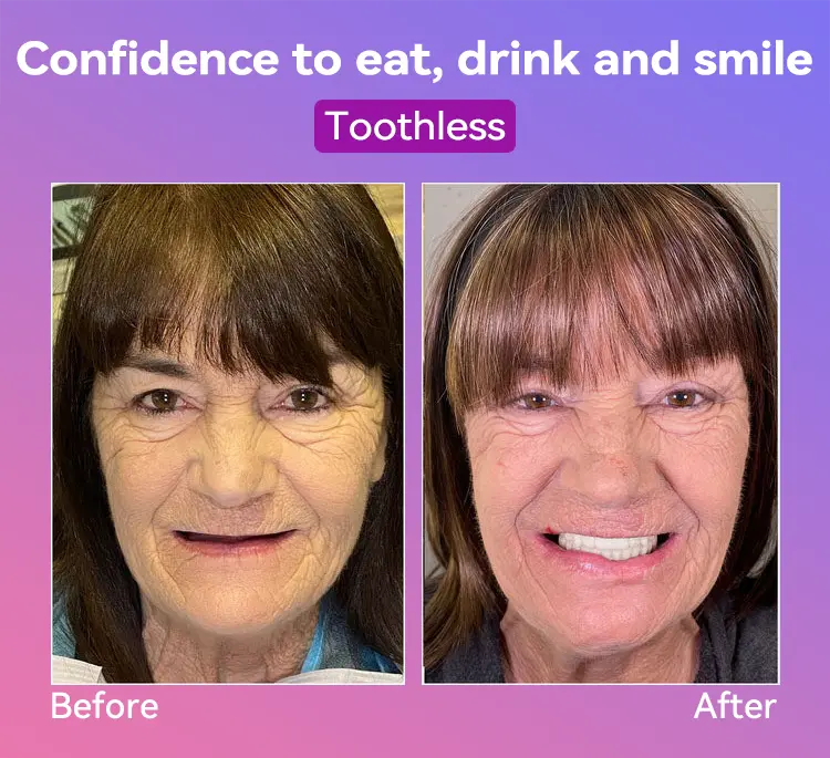 Latest Premium Comfort Dentures - Image 10