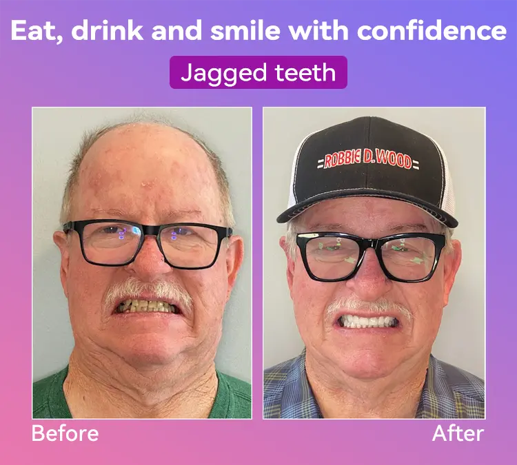 Latest Premium Comfort Dentures - Image 12
