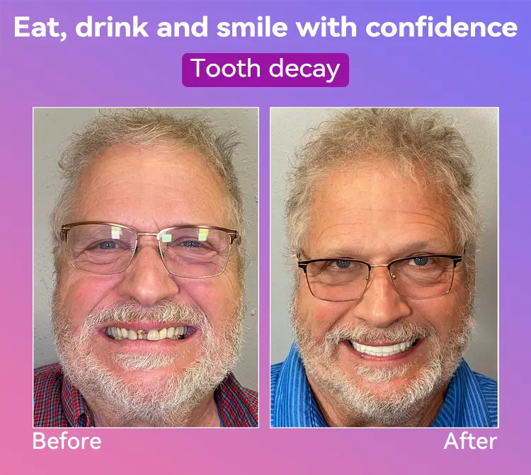 Latest Premium Comfort Dentures - Image 15