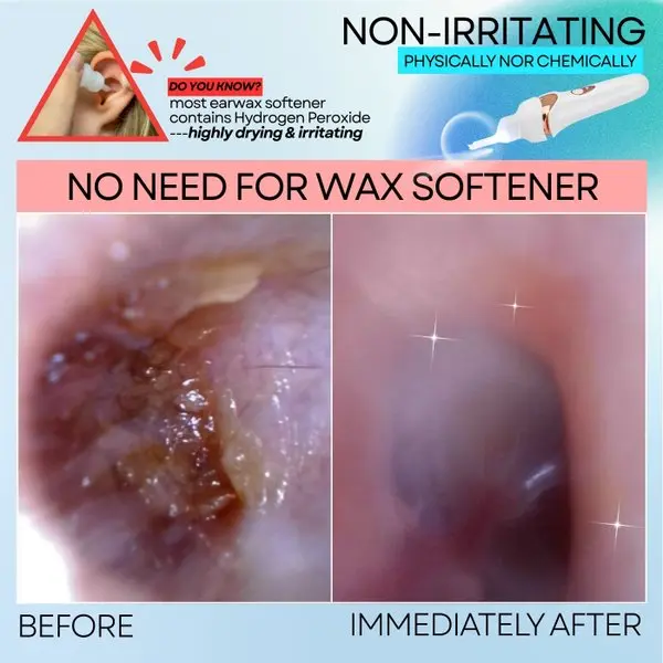 Electric Ear Wax Vacuum Cleaner - Image 3