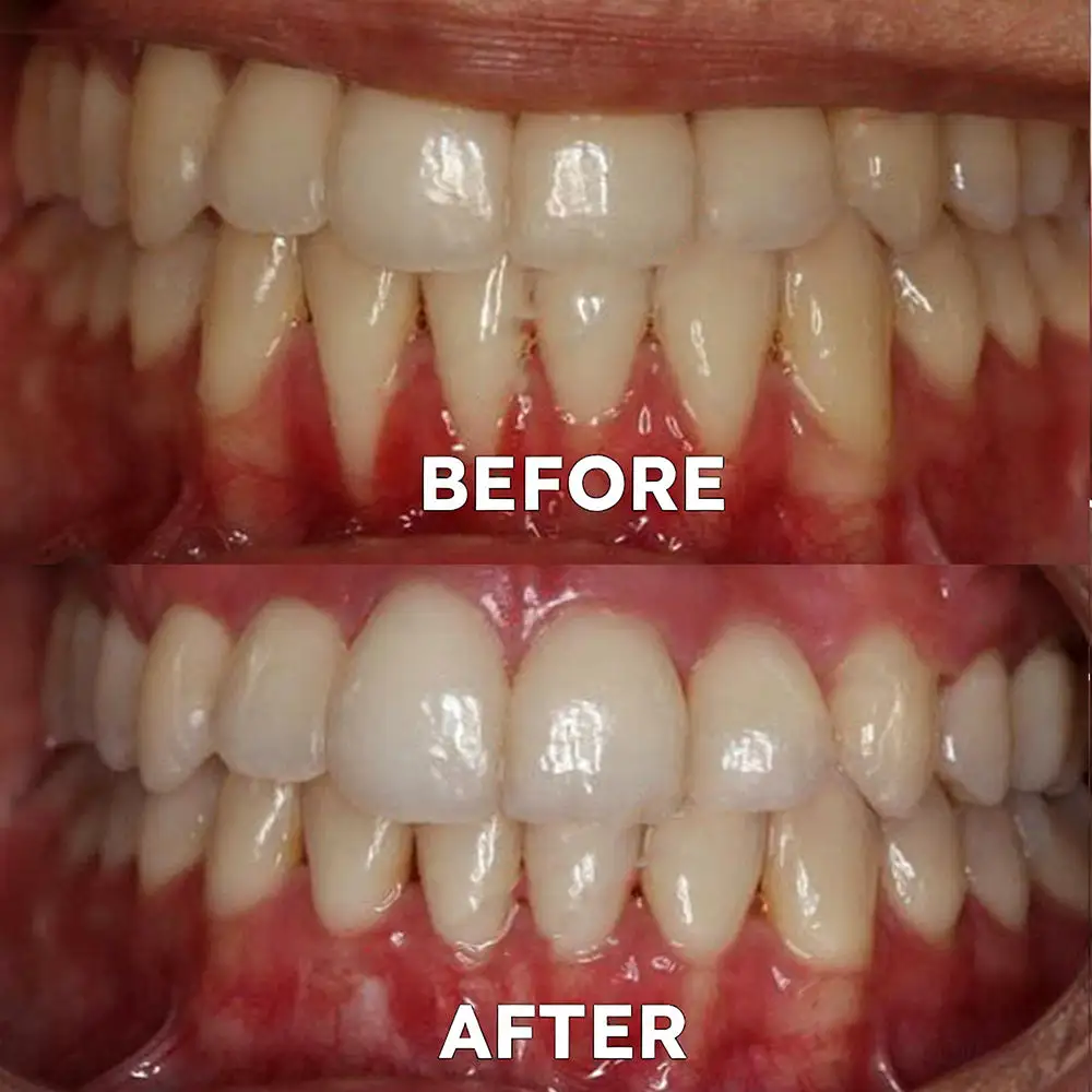 Fluoride-Free Nano Hydroxyapatite Tooth Powder - Image 5