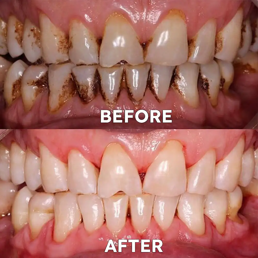 Fluoride-Free Nano Hydroxyapatite Tooth Powder - Image 7