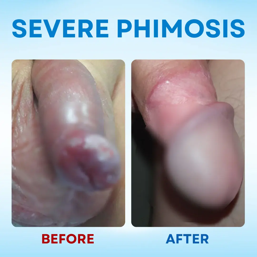 7-Day Redundant Prepuce Corrective Gel - Image 6