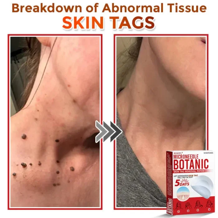 MicroNeedle Skin Growth Removal Patch - Image 5