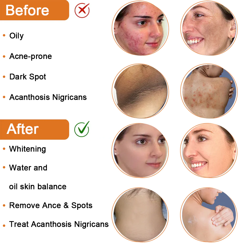 Cleansing Lotion for Acne & Spots & Acanthosis Nigricans Congratulations - Image 3
