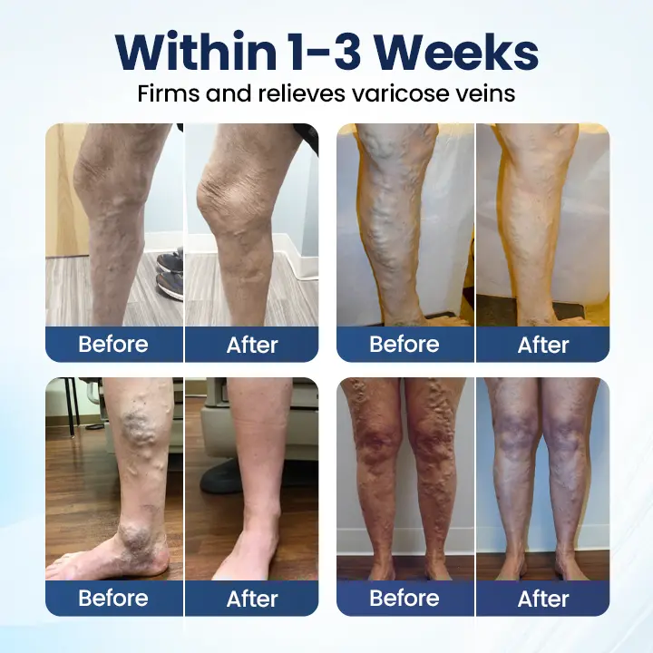 Deep Vein Repair Microneedle Patch - Image 2