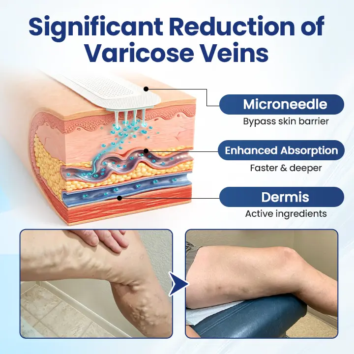 Deep Vein Repair Microneedle Patch - Image 5