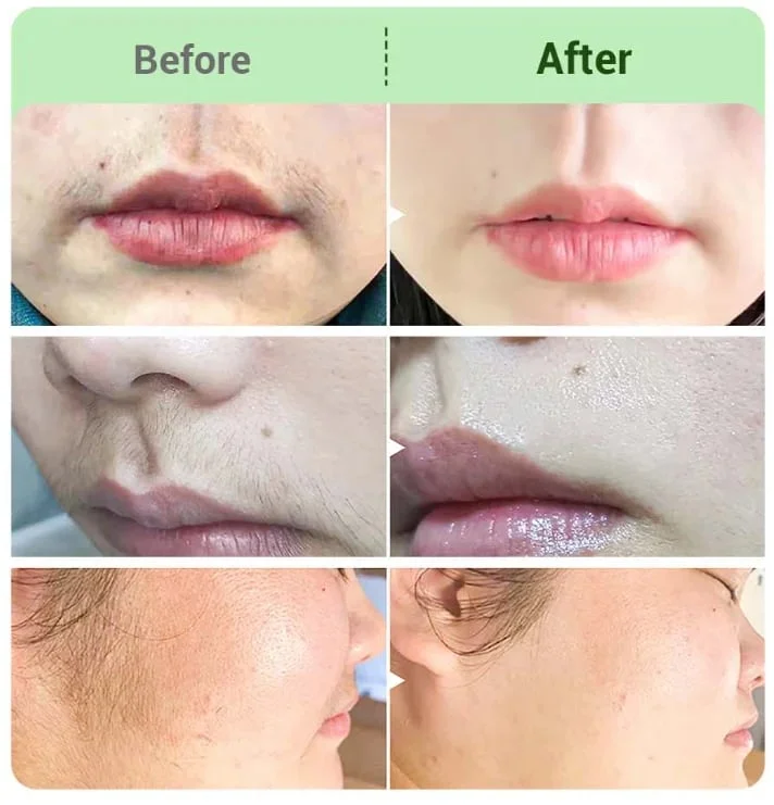 Painless Hair Removal Cream for Hormonal Facial Hair - Image 5