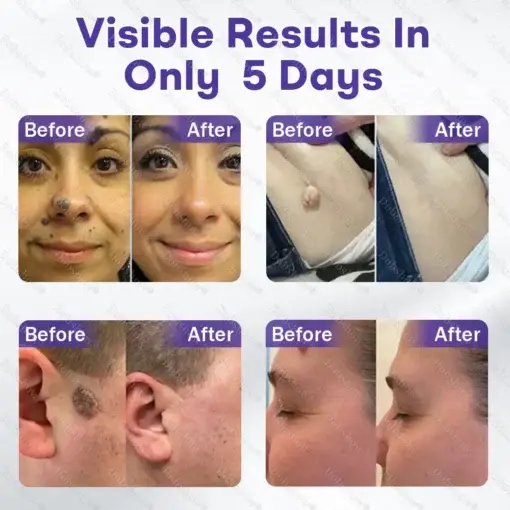 Wart and mole removal microneedle patch - Image 3