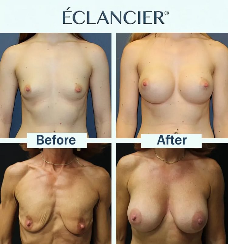 Targeted Breast Enhancement Advanced Nano Microneedle Patch - Image 4