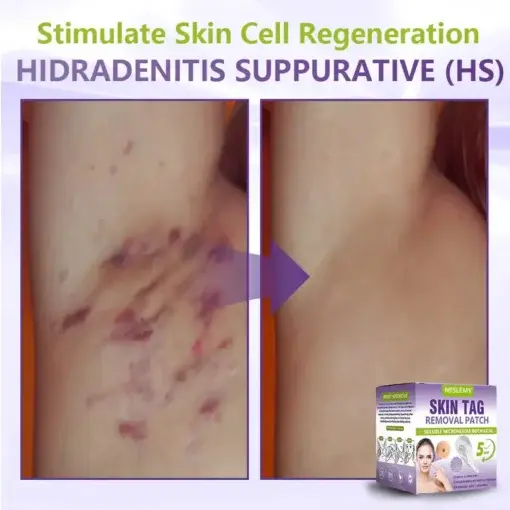 Soluble Microneedle Botanical Skin Tag Removal Patch - Image 10