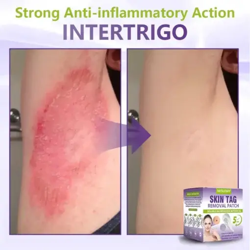 Soluble Microneedle Botanical Skin Tag Removal Patch - Image 12