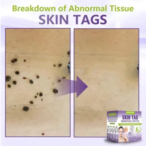 Soluble Microneedle Botanical Skin Tag Removal Patch - Image 5