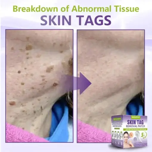 Soluble Microneedle Botanical Skin Tag Removal Patch - Image 6