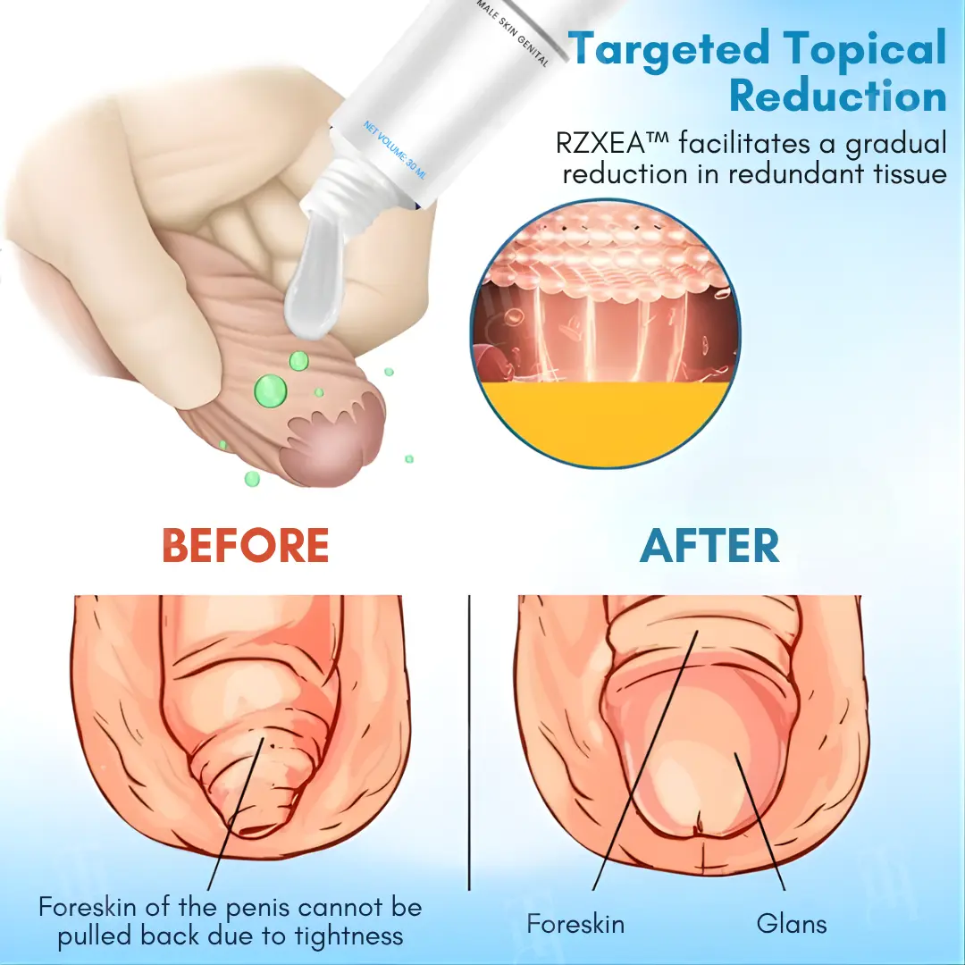 Foreskin Elasticity Gel:The Non-Surgical Solution for Tight Foreskin - Image 4