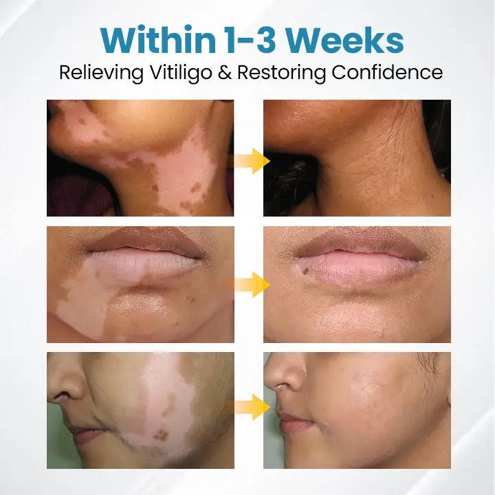 DermaBeam Vitiligo Therapy Device - Image 2