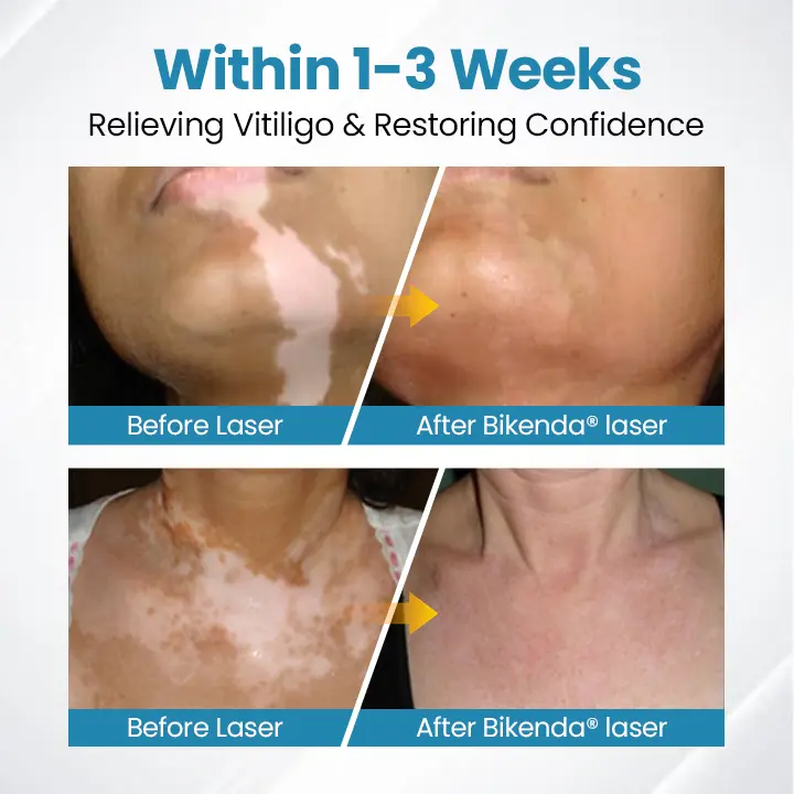 DermaBeam Vitiligo Therapy Device - Image 5
