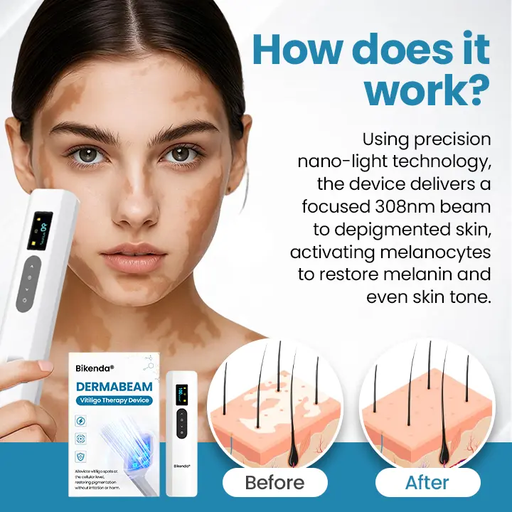 DermaBeam Vitiligo Therapy Device - Image 8