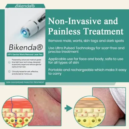 HPV Genital Warts Removal Laser Pen - Image 3