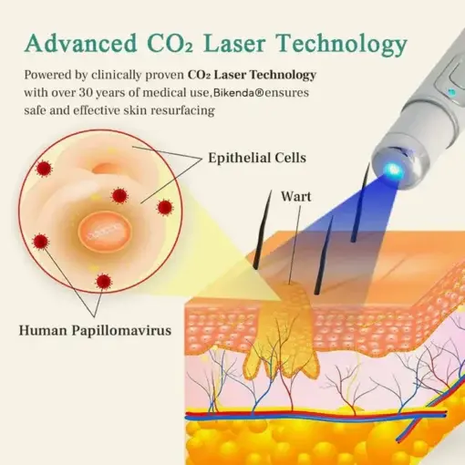 HPV Genital Warts Removal Laser Pen - Image 4