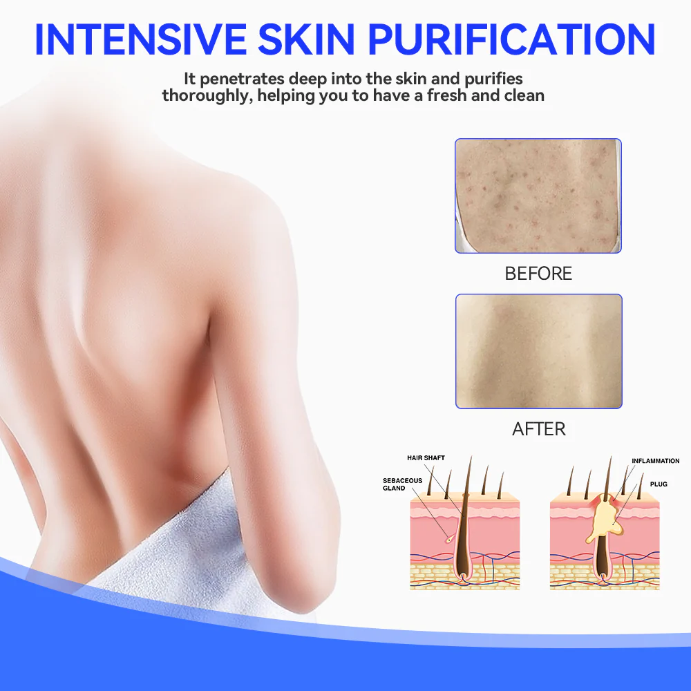 Keratosis Pilaris & Akne Behandlung Körper Erfrischende Creme - Image 3